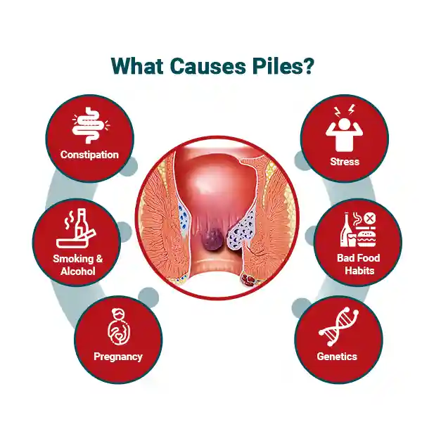 Best ayurvedic medicine for piles, piles medicine online india,