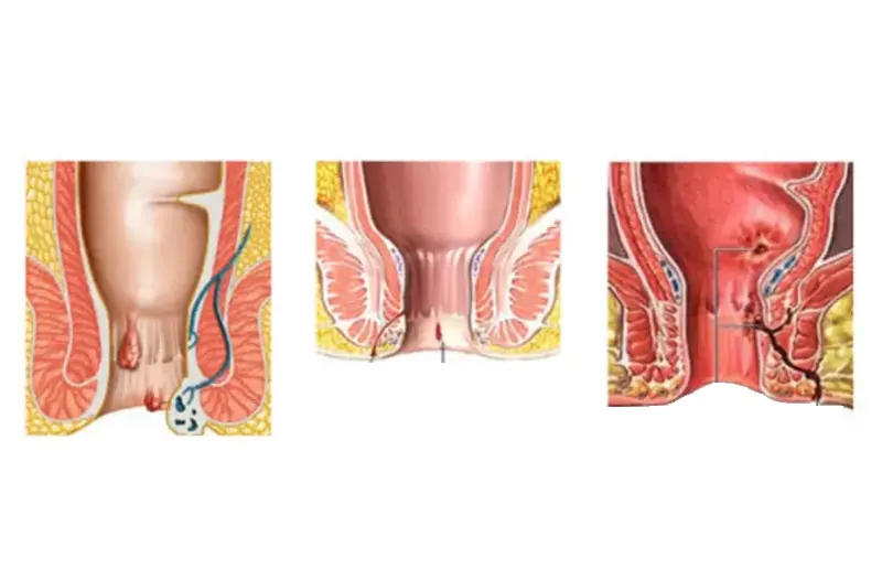 Piles,Fissure,Fistula
