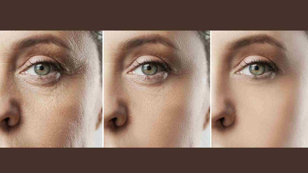How Diabetes Causes Premature Skin Ageing