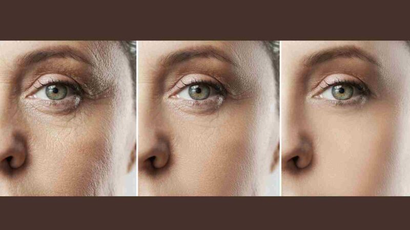 How Diabetes Causes Premature Skin Ageing